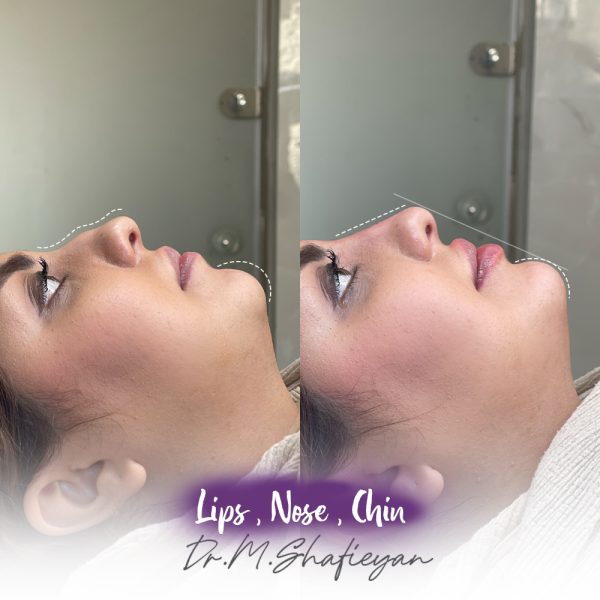 تزریق فیلر لب